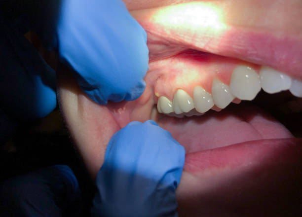 Best Emergency Broken Tooth Repair in Port Neches, TX